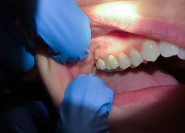 Best Emergency Dentist for Knocked-Out Tooth in Centralia, MO