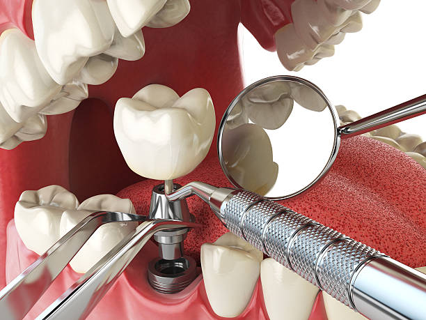 Best Emergency Root Canal Treatment in Centralia, MO